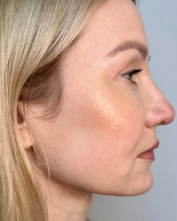 8 weeks after Endolift with Dr Rohit Seth, 28 February 2023, sharper jawline and tighter under chin
