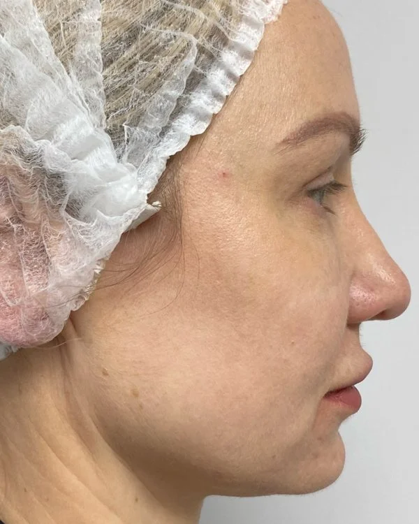 Before Endolift, 10 January 2023, lower face and neck in profile