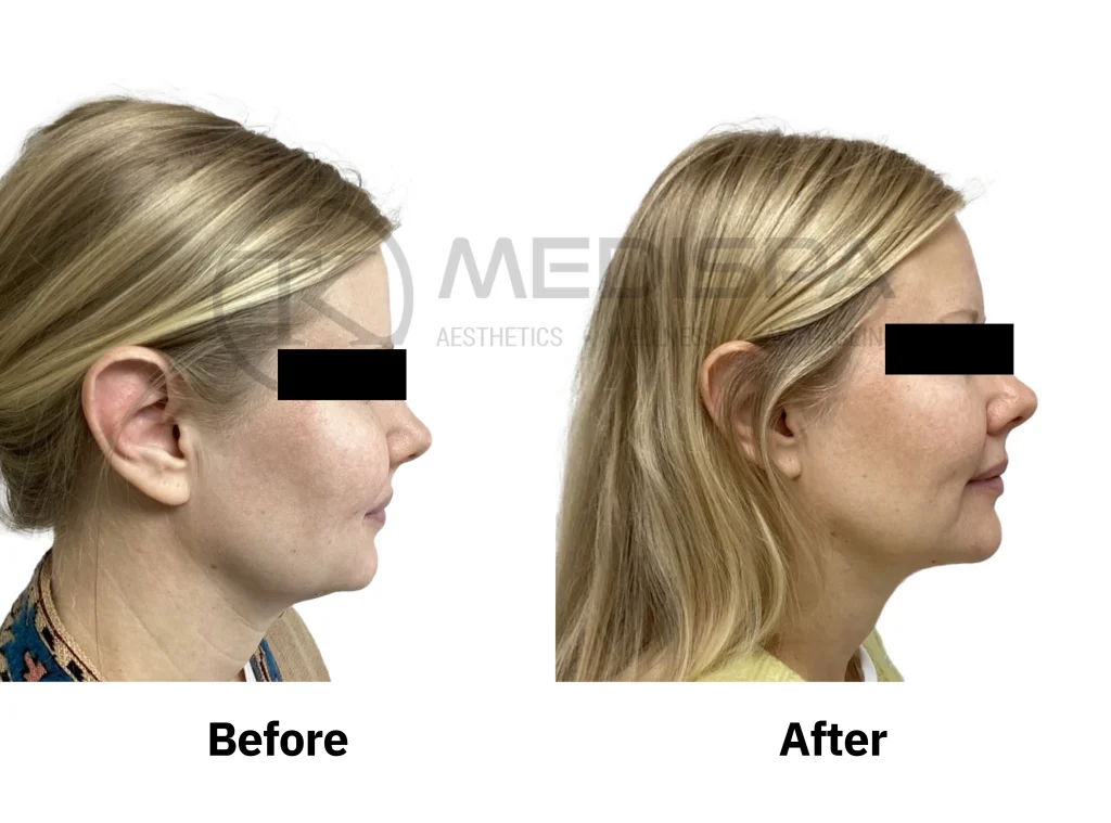 Endolift before and after: jawline and neck, side profile, TK Medispa London