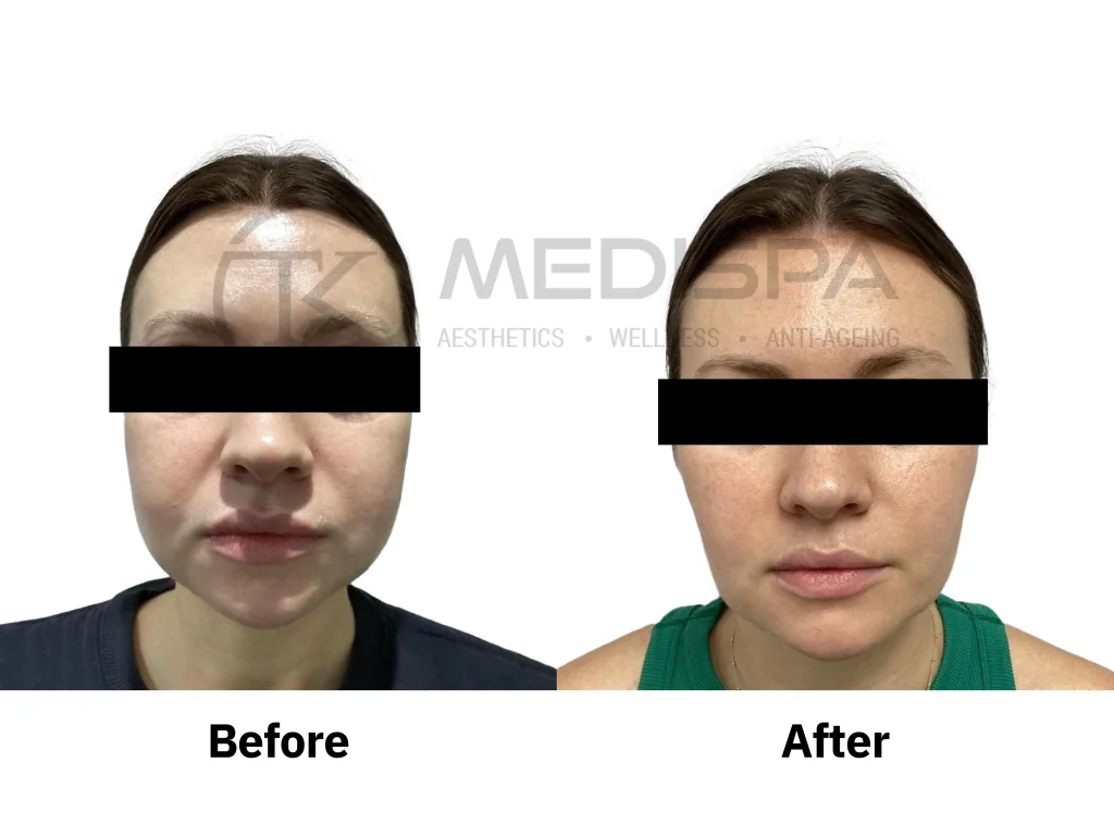 Endolift before and after: lower face, front view