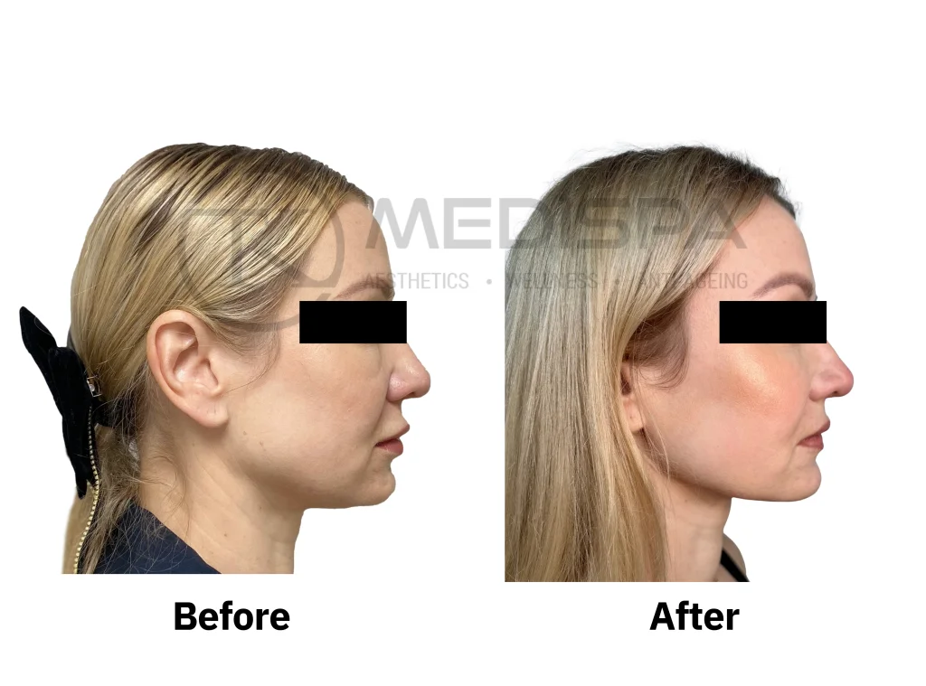 Endolift before and after: jowls and under chin, side profile