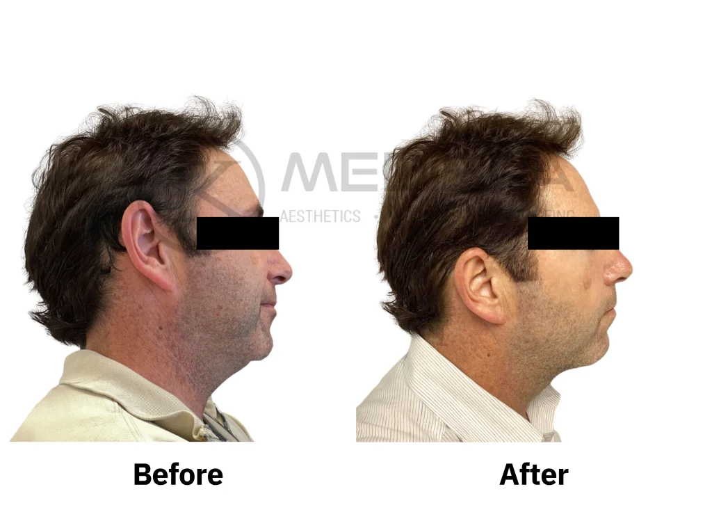 Endolift before and after: male jawline and neck