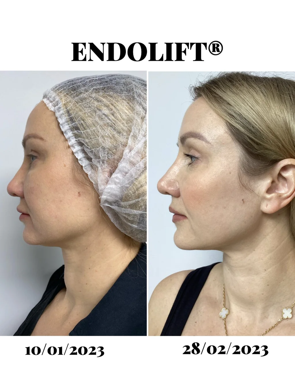 Endolift before and after, 10 January to 28 February 2023