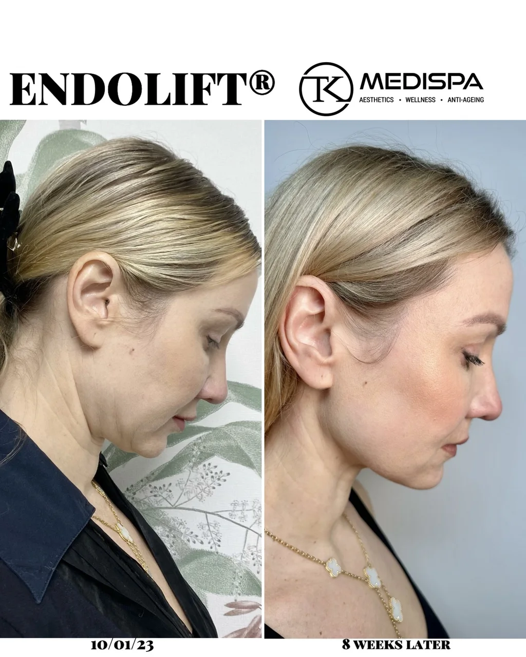 Endolift before and after at 8 weeks, three quarter view