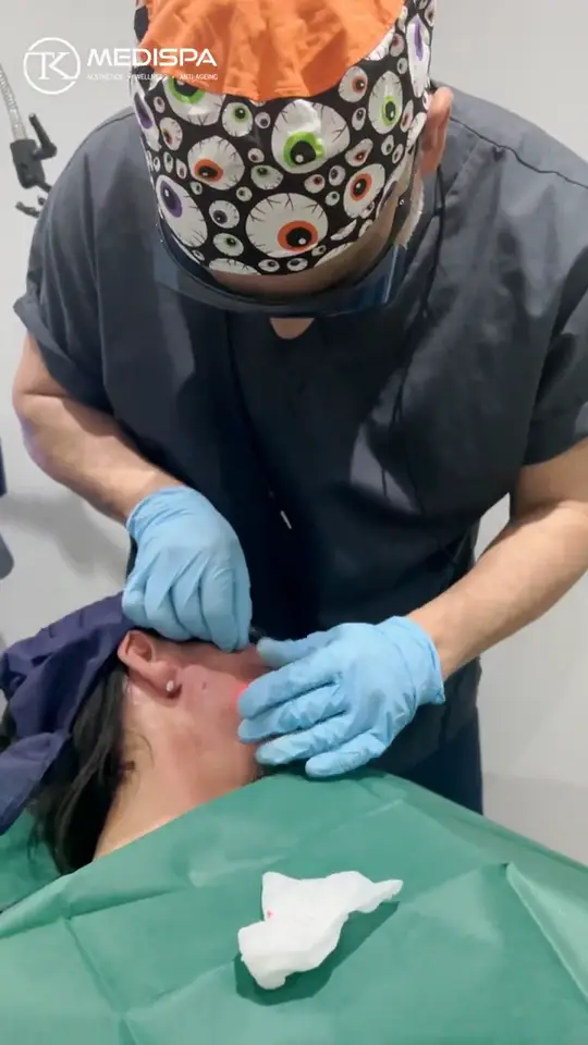 Dr Rohit Seth treating the jawline and neck with Endolift.