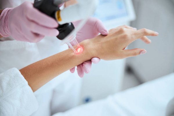 CO2 treatment | A close-up image of a doctor giving laser treatment to their patient's arm.