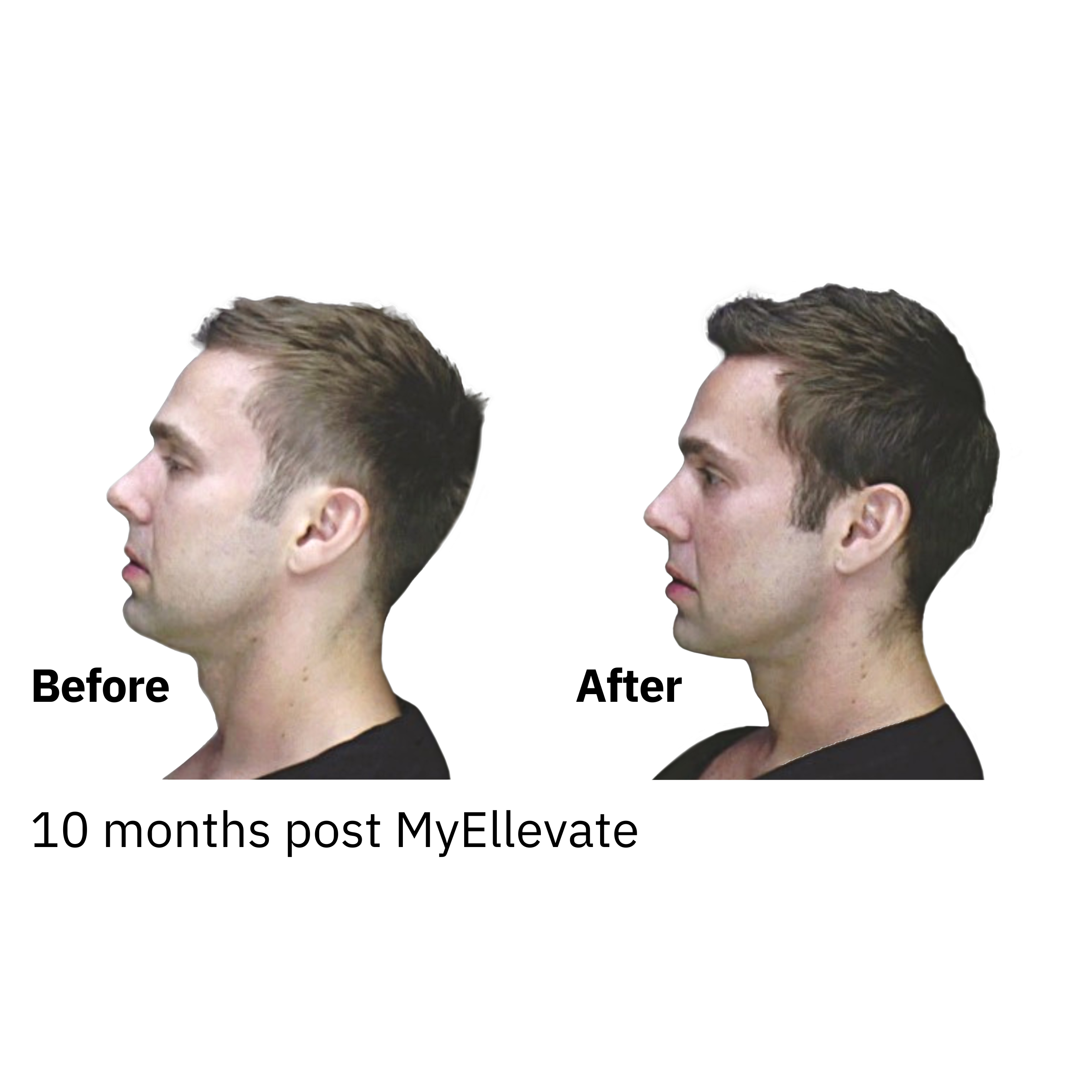 Neck Lift | Before and after images of the MyEllevate operation results.